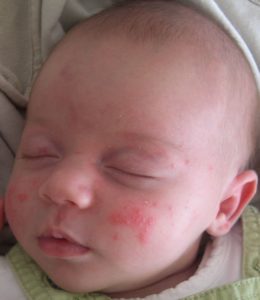 bouton rouge visage bebe acne