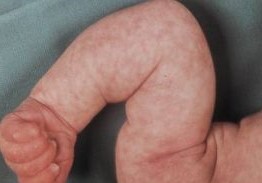 fièvre bébé marbrures