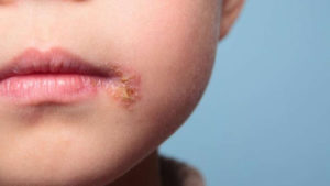 surinfection boutons varicelle